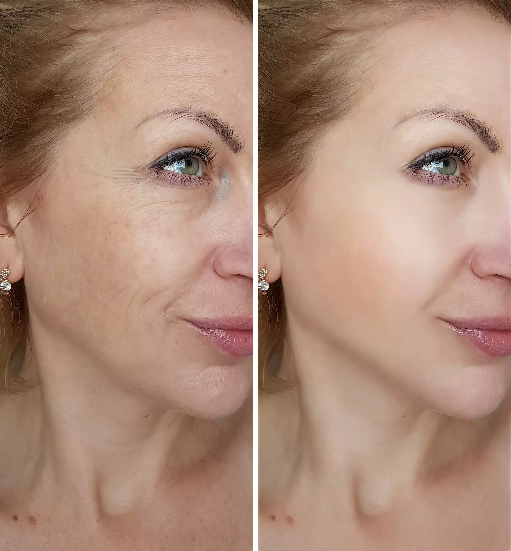 Laser Hair Reduction in Dallas