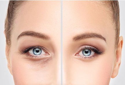 PRF & PRP Under-Eye Rejuvenation in Dallas