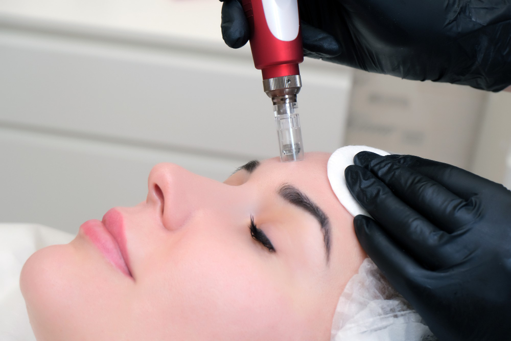 SkinPen® Microneedling & Collagen Induction Therapy in Dallas